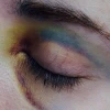 Lupus-cor_